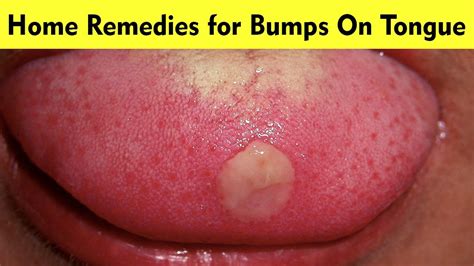 Sore Throat And Bumps On Tongue