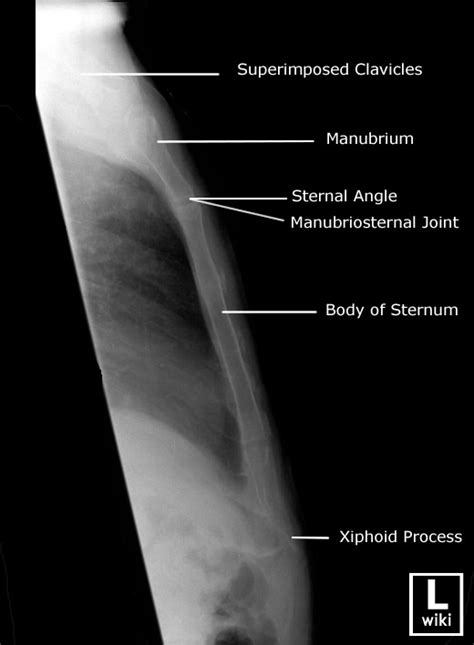 Diagram Sternum Anatomy Oblique Sternal Rao X Ray Diagram Sexiz Pix