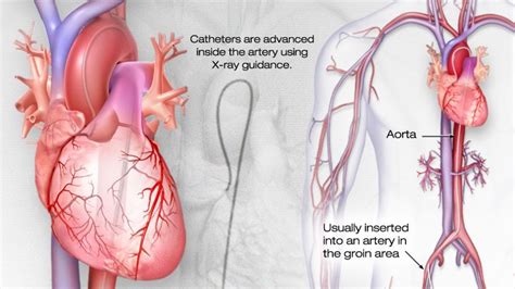 63 heart test catheterization testheart