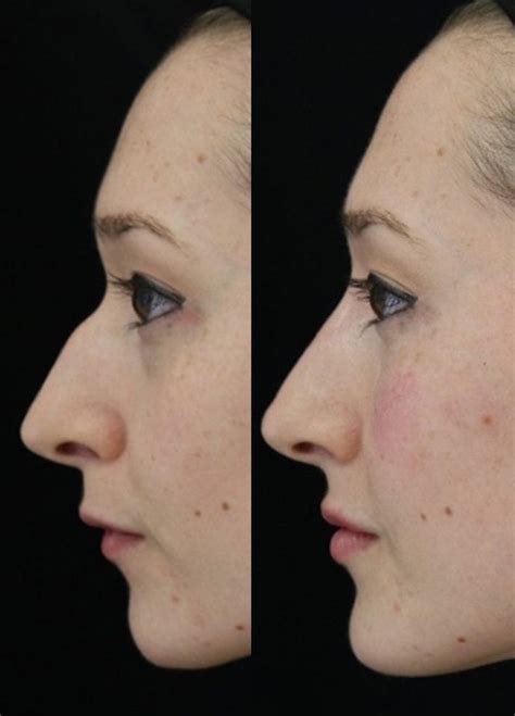 Non Surgical Nose Reshaping In London Phi Clinic London