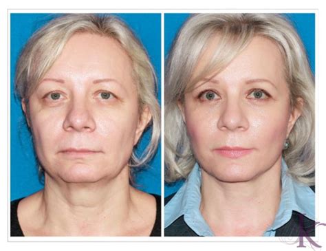 Facelift Case 8 Dr Vasyukevich Facial Plastic Surgeon Nyc