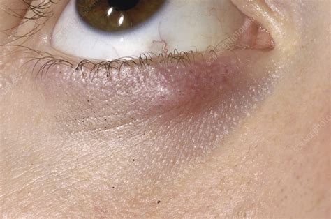 Eyelid Cyst Chalazion Causes Symptoms Treatment Eyelid Cyst
