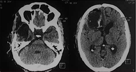 Unusual Coexistence Of An Epidermoid Cyst With An Atypical Meningioma
