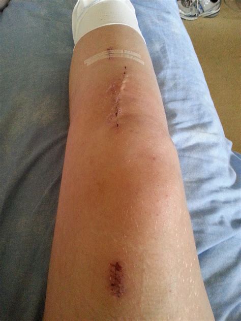 High Tibial Osteotomy Two Week Old Scars From Surgery Fur Flickr