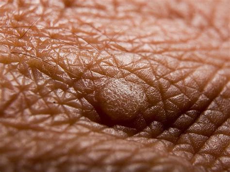 Types Of Warts Pictures Symptoms And Causes