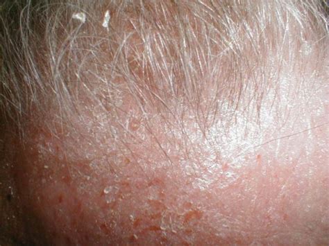 Severe Atopic Dermatitis Pictures Symptoms And Pictures