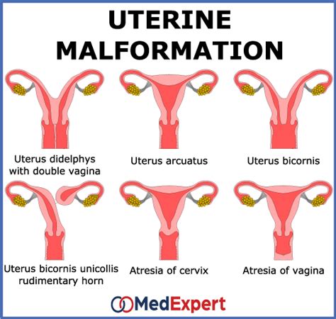 Abnormal Uterus Anatomy Treatment And Pregnancy MED Expert
