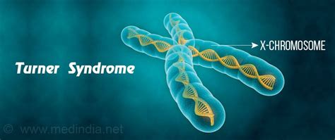 Turner Syndrome Causes Types Symptoms Diagnosis Treatment
