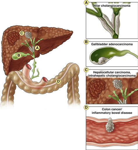 Primary Sclerosing Cholangitis As A Premalignant Biliary Tract Disease
