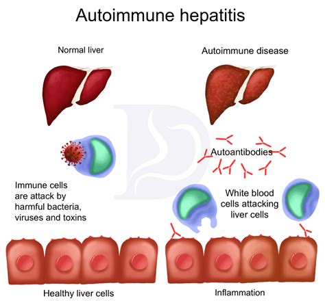 Learn About Autoimmune Hepatitis The Gi Docs