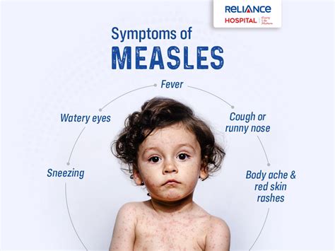 Symptoms Of Measles