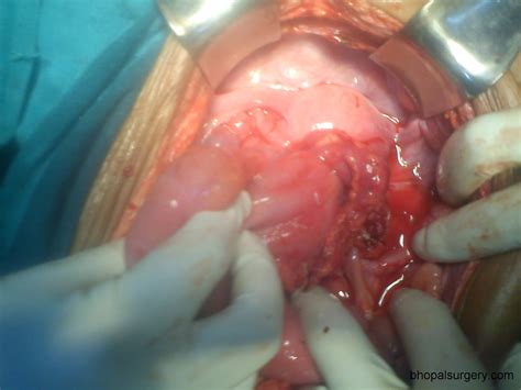 Right iliac fossa abdominal pain is a common reason for emergency ward admissions, its etiology is difficult to diagnose. Bhopal Surgery: Photo Gallery: Gastrointestinal ...