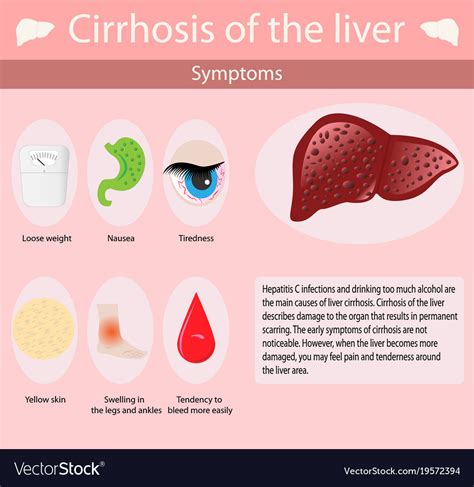 Symptoms Infectious Mononucleosis Royalty Free Vector Image