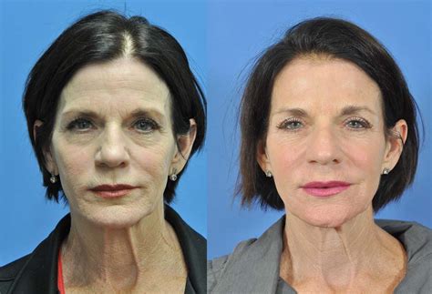 Laser Resurfacing Vs Rhinoplasty Unveiling The Pros And Cons Justinboey