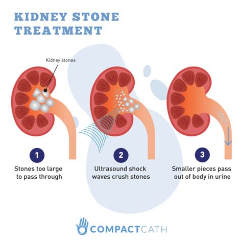Kidney Stones The Ultimate Beginners Guide Compactcath