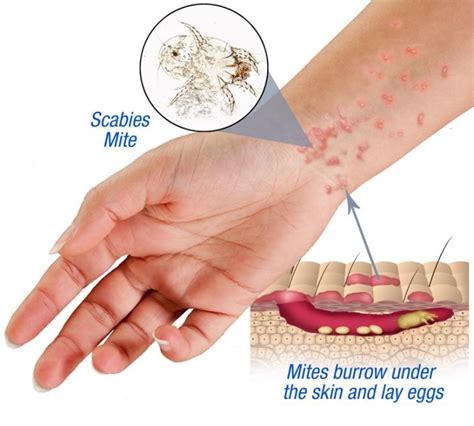 Scabies Puskesmas Dinoyo