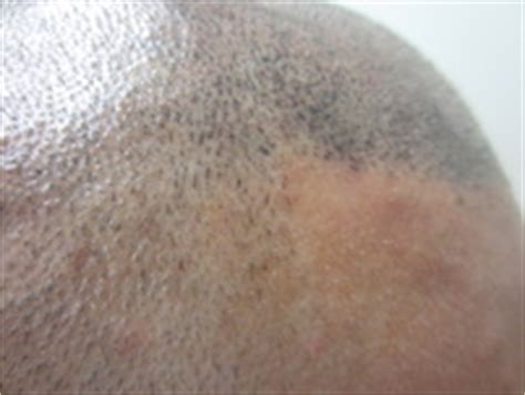Scalp Micro-Pigmentation versus Hair Transplant - Houston ...