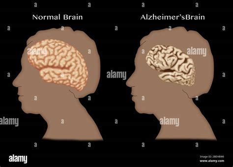 Alzheimer Und Normale Gehirne Vergleich Stockfotografie Alamy