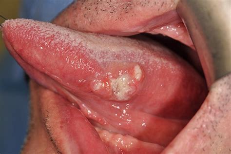Carcinoma Of The Tongue Cleadon Village Dental Practicecleadon