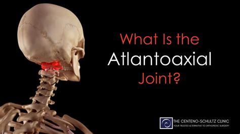What Is The Atlantoaxial Joint Centeno Schultz Clinic