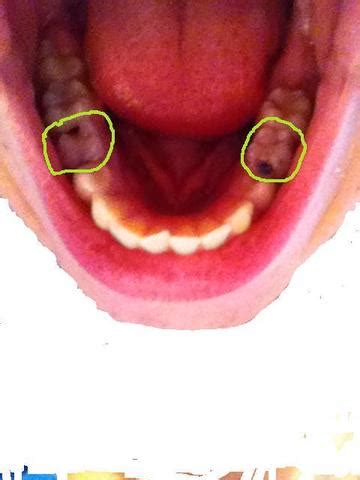 Eine wurzelbehandlung ist notwendig, wenn starke schmerzen am zahn vorhanden sind bzw. zahnarzt ? loch im milchzahn wurzelbehandlung ? (Zähne ...