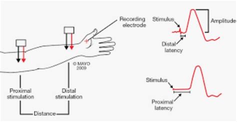 Nerve Conduction Studies Hand Orthobullets