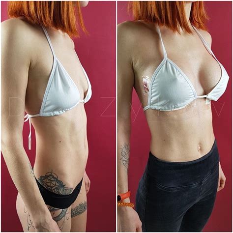Breast Implants Removal Before And After Dominique Mezquita