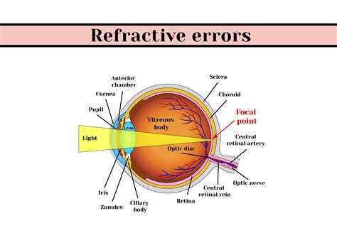 Refractive Errors Causes Symptoms And Preventive Measures Maxivision