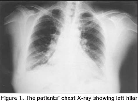 Figure 1 From Mediastinal Tuberculous Lymphadenitis With Anthracosis As