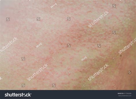 Стоковая фотография 617296289 Skin Rashes Allergies Contact Dermatitis