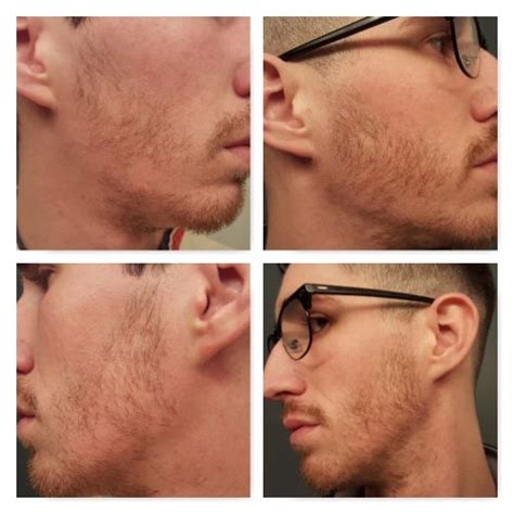 The men attempting to grow thicker beards with rogaine. 5 TIPS: Why Do I Have Patchy Bald Spots In My Beard & How ...