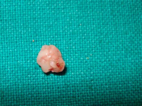 Pyogenic Granuloma Hyperplastic Lesion Of The Gingiva Case Reports