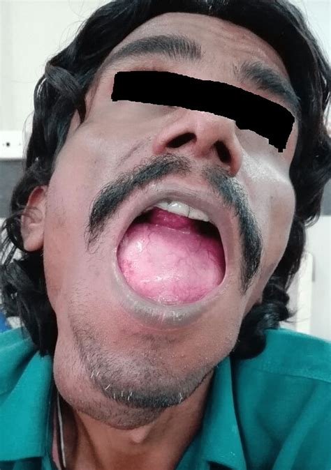 Cureus An Unusual Case Of Sublingual Epidermoid Cyst Mimicking