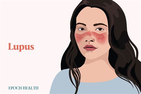 The Essential Guide To Lupus Symptoms Causes Treatments And Natural