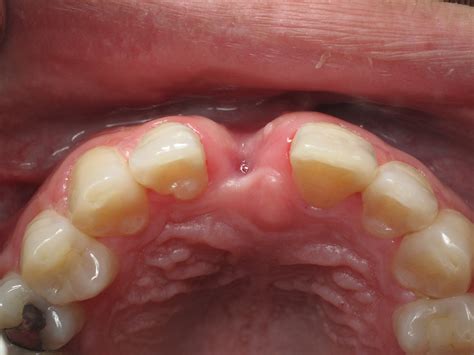 Sore Roof Of Mouth Just Behind Front Teeth Teeth Bonding