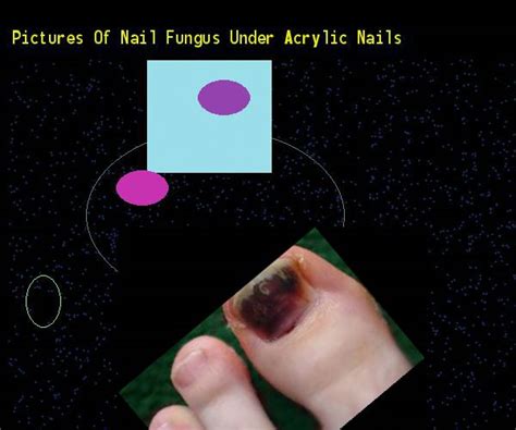 Acrylic nails and fungus nail ideas nail photo gallery. Pictures of nail fungus under acrylic nails - Nail Fungus ...