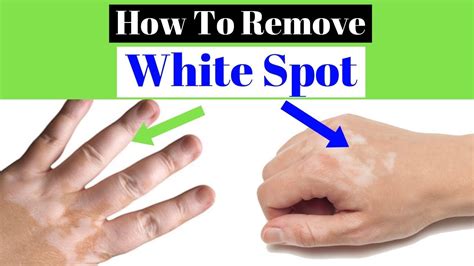 white spots on skin causes and treatment printable templates protal