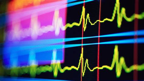 Heart Rhythm Disorder May Be Tied to Wider Range of Ills ...