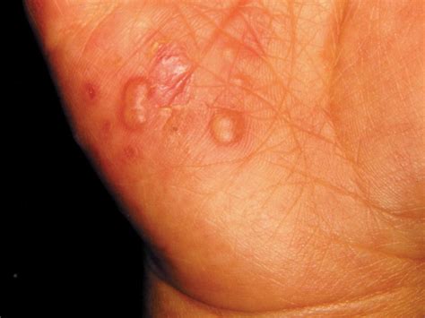 Hand Foot And Mouth Disease Article Statpearls