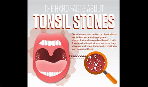 The Hard Facts About Tonsil Stones Infographic Visualistan