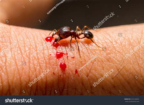 Angry Ant Biting Human Skin Blood Stock Photo 223144054 Shutterstock