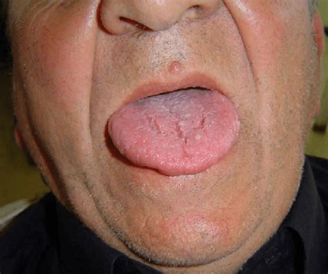 Tongue With Fissured Appearance And Papillar Lesions In Dorsal Face
