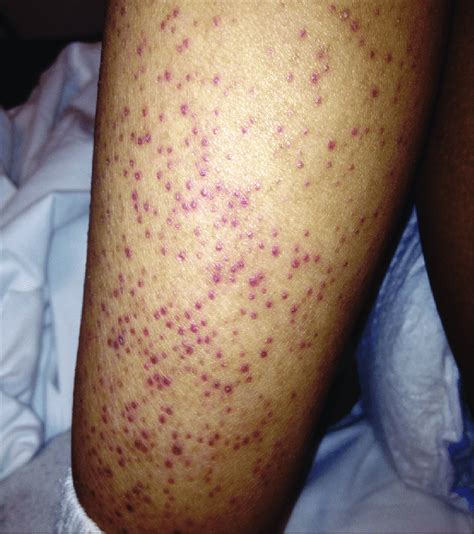 Collection 96 Pictures Red Rash On Lower Legs Above Ankles Photos Full Hd 2k 4k