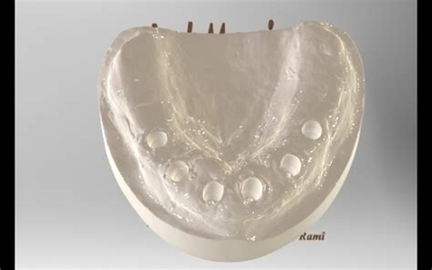 Bone loss occurs in infectious conditions, which can lead to standard dental implant failure. 3D Printed Dental Implant Model by LabMagic 3D CAD | Pinshape