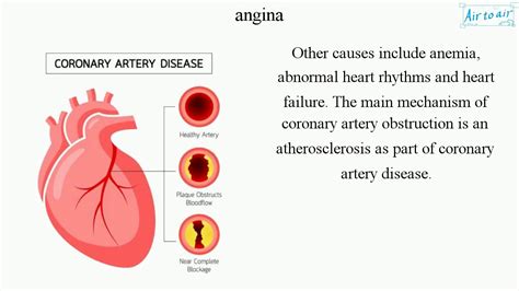Angina English Medical Terminology For Medical Students Youtube