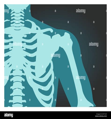 X Ray Shot Of Shoulder Human Body Bones Radiography Rib Cage Chest And Arm Vector