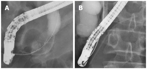 Pancreatic Stents For The Prevention Of Post Endoscopic Retrograde