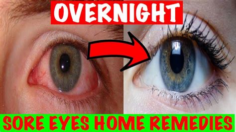 How To Get Rid Of Sore Eyes Naturally 14 Effective Natural Home
