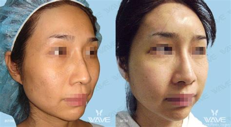 Facial Fat Transfer In Los Angeles Wave Plastic Surgery