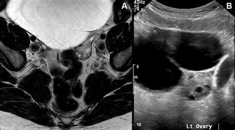 Dilemma Of The Giant Abdominal Cyst Bmj Case Reports